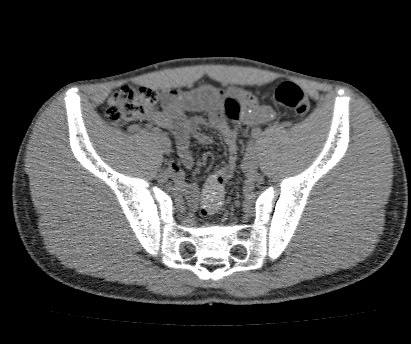 File:Anterior inferior iliac spine avulsion fracture (Radiopaedia 81312-94999 Axial non-contrast 34).jpg