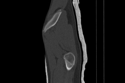 Anterior inferior iliac spine avulsion injury (Radiopaedia 88666-105376 Sagittal bone window 13).jpg