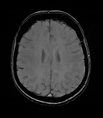 File:Anterior temporal lobe perivascular space (Radiopaedia 40946-43650 Axial SWI 58).png