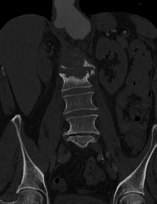 Anterior vertebral scalloping (abdominal aortic aneurysm) (Radiopaedia 66744-76067 Coronal bone window 30).jpg