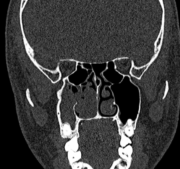 Antrochoanal polyp (Radiopaedia 30002-30554 Coronal bone window 47).jpg