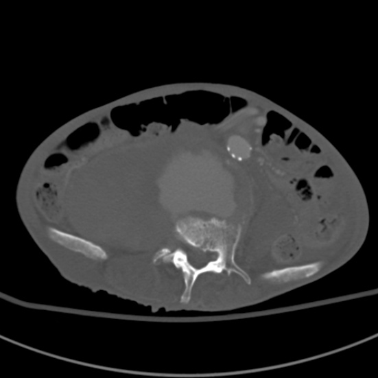 Aortic aneurysm with spinal destruction (Radiopaedia 42301-45410 Axial bone window 63).jpg