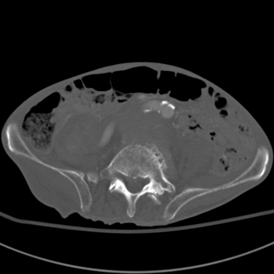 Aortic aneurysm with spinal destruction (Radiopaedia 42301-45410 Axial bone window 71).jpg