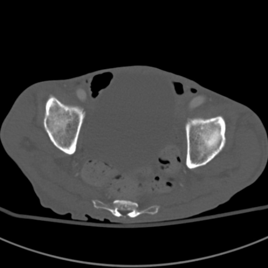 Aortic aneurysm with spinal destruction (Radiopaedia 42301-45410 Axial bone window 97).jpg