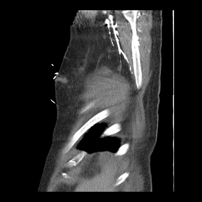 Aortic arch graft infection (FDG PET-CT) (Radiopaedia 71975-82437 C 63).jpg