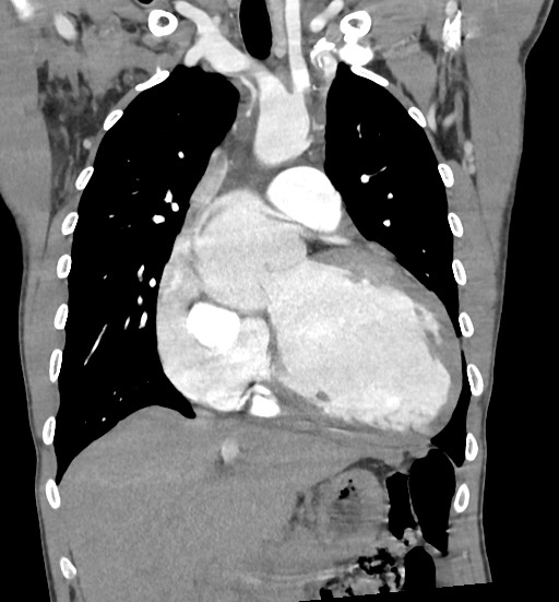 Aortic coarctation with aneurysm (Radiopaedia 74818-85828 C 47).jpg