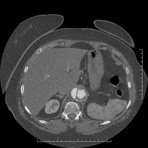 Aortic dissection- Stanford A (Radiopaedia 35729-37268 B 32).jpg