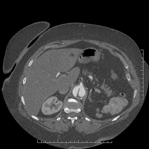 Aortic dissection- Stanford A (Radiopaedia 35729-37268 B 41).jpg