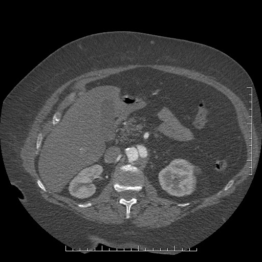 File:Aortic dissection- Stanford A (Radiopaedia 35729-37268 B 56).jpg