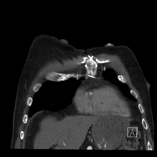 File:Aortic dissection (CTPA) (Radiopaedia 75506-86750 B 11).jpg