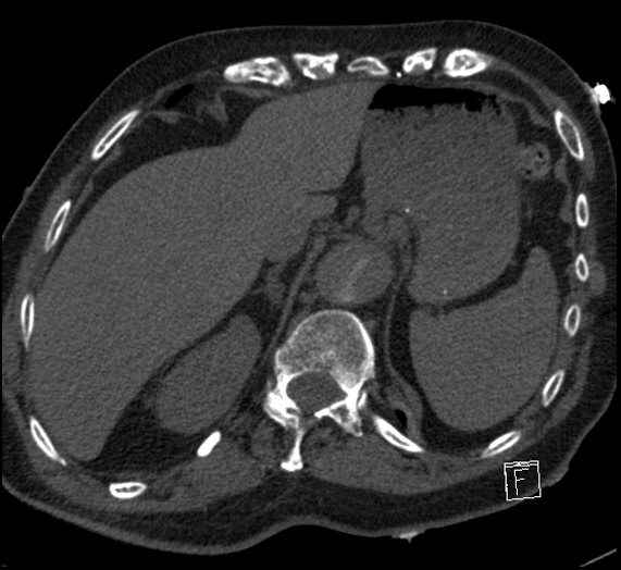 Aortic dissection (CTPA) (Radiopaedia 75506-86751 Axial C+ CTPA 125).jpg