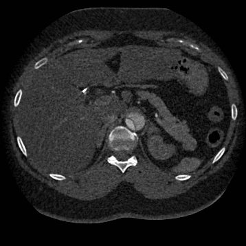 Aortic dissection (Radiopaedia 57969-64959 A 322).jpg