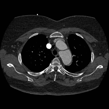 Aortic dissection (Radiopaedia 57969-64959 A 89).jpg