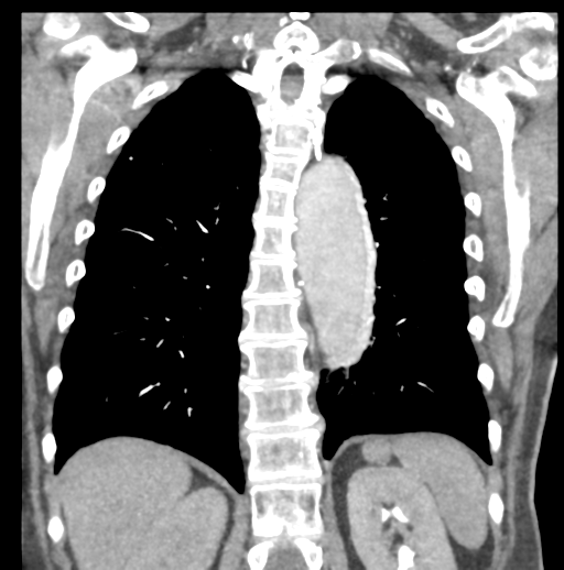 File:Aortic dissection - Stanford type B (Radiopaedia 50171-55512 B 63).png