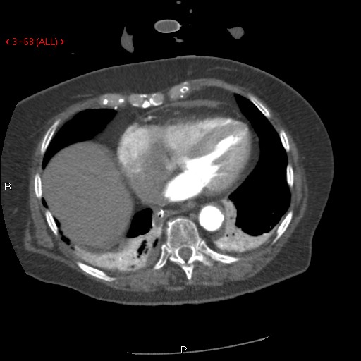 Aortic intramural hematoma (Radiopaedia 27746-28001 A 68).jpg
