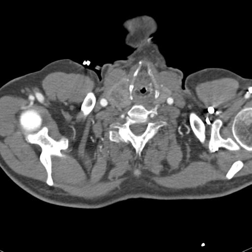 Aortic intramural hematoma (Radiopaedia 31139-31838 B 1).jpg