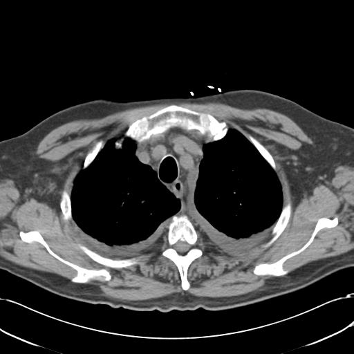 Aortic intramural hematoma (Radiopaedia 34260-35540 Axial non-contrast 13).png