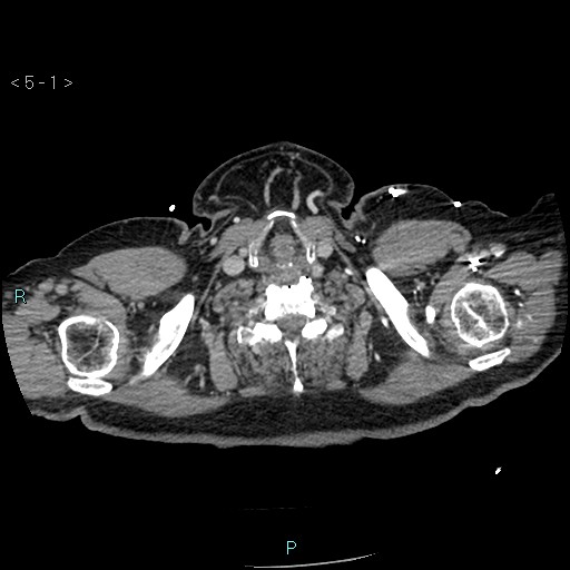 Aortic intramural hematoma (Radiopaedia 48463-53380 C 1).jpg