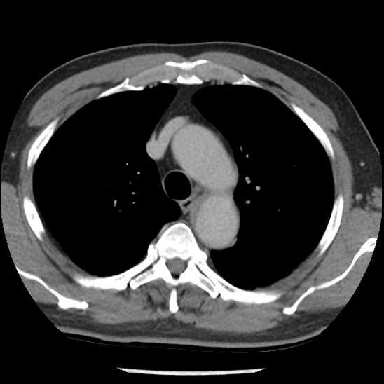 Aortic intramural hematoma (type B) (Radiopaedia 79323-92387 Axial C+ delayed 14).jpg