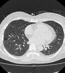 File:Aortic valve endocarditis (Radiopaedia 87209-103485 Axial lung window 62).jpg
