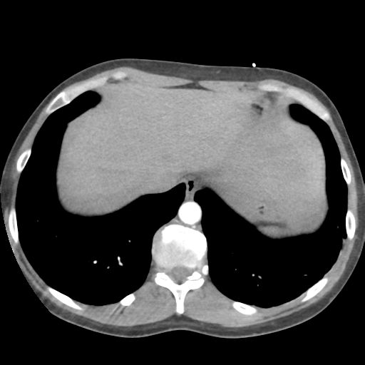 Aortic valve non-coronary cusp thrombus (Radiopaedia 55661-62189 B 43).png