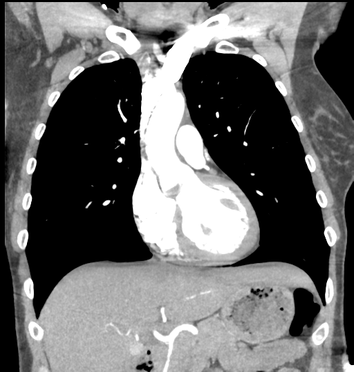 File:Aortic valve non-coronary cusp thrombus (Radiopaedia 55661-62189 C 31).png