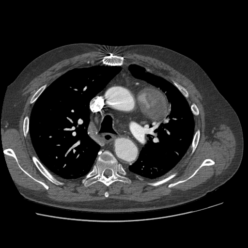 File:Aorto-coronary bypass graft aneurysms (Radiopaedia 40562-43157 A 39).png