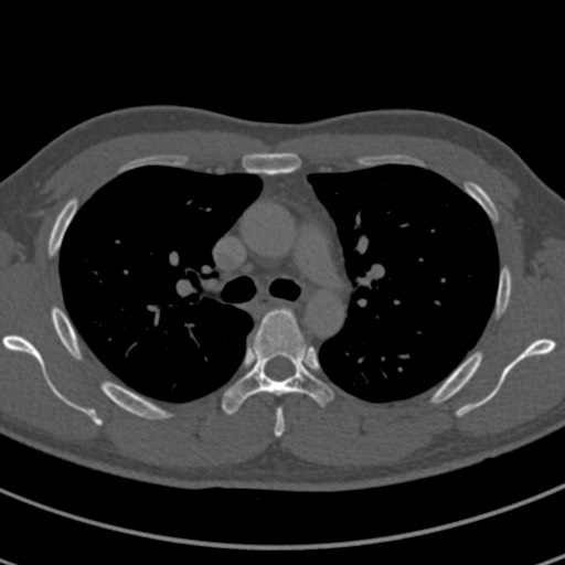 Apical lung mass mimic - neurogenic tumor (Radiopaedia 59918-67521 Axial bone window 31).jpg