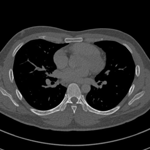 File:Apical lung mass mimic - neurogenic tumor (Radiopaedia 59918-67521 Axial bone window 44).jpg