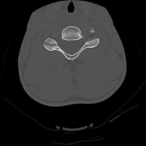 Apical pneumothorax on cervical spine CT (Radiopaedia 45343-49368 Axial bone window 53).jpg