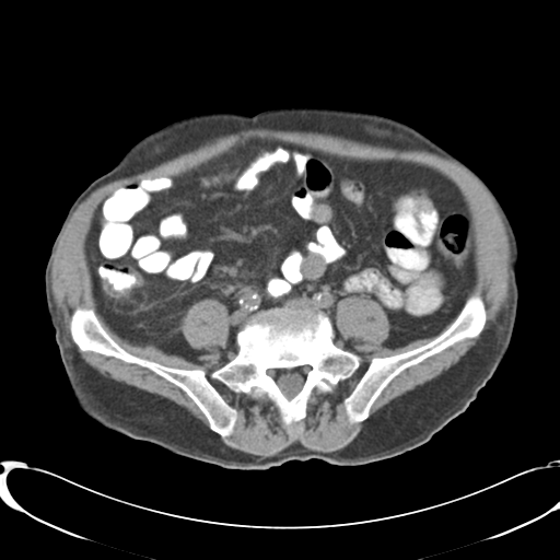 File:Appendiceal abscesses (Radiopaedia 50999-56542 Axial non-contrast 53).png