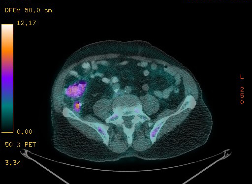 Appendiceal adenocarcinoma complicated by retroperitoneal abscess (Radiopaedia 58007-65041 Axial PET-CT 151).jpg