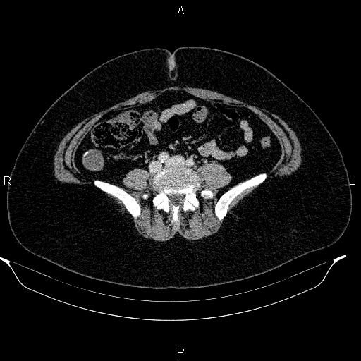Appendiceal mucocele (Radiopaedia 83280-97688 Axial With contrast 69).jpg