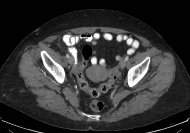 Appendicitis due to chicken fibula (Radiopaedia 74314-85198 A 42).jpg