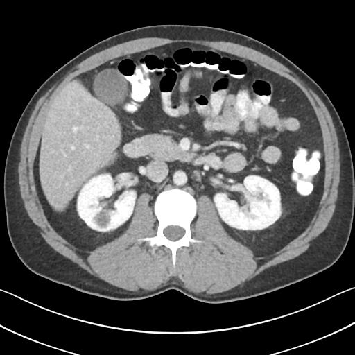 File:Appendicitis with cecal bar sign (Radiopaedia 31878-32830 B 33).jpg