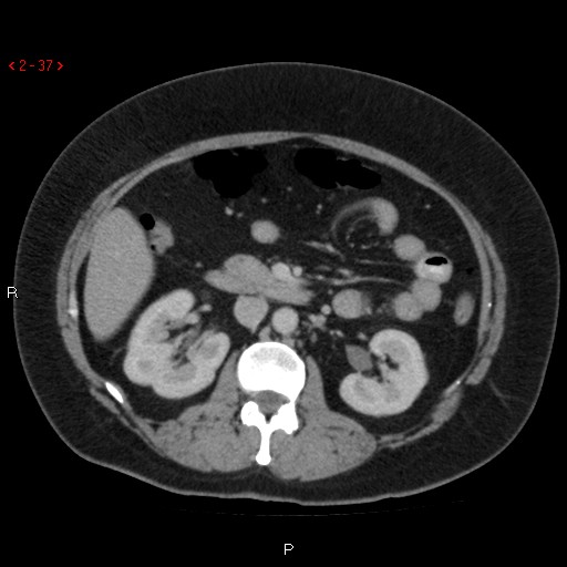 Appendicitis with microperforation- promontoric type (Radiopaedia 27268-27442 C 25).jpg