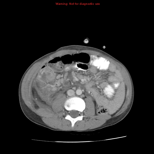 File:Appendicitis with phlegmon (Radiopaedia 9358-10046 A 40).jpg