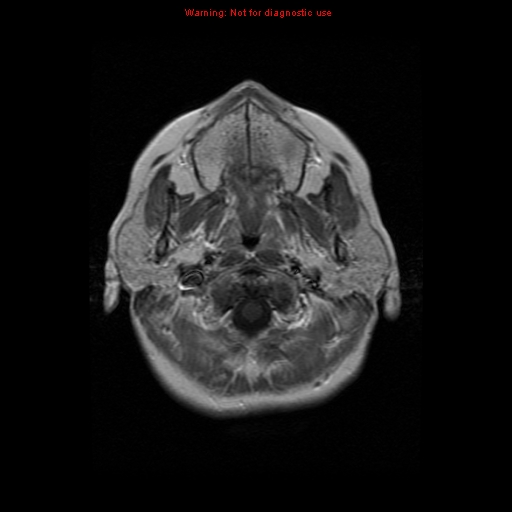File:Arachnoid cyst (Radiopaedia 10869-11297 Axial T1 C+ 19).jpg