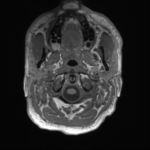 File:Arachnoid cyst with subdural hematoma (Radiopaedia 85892-101743 Axial T1 5).png