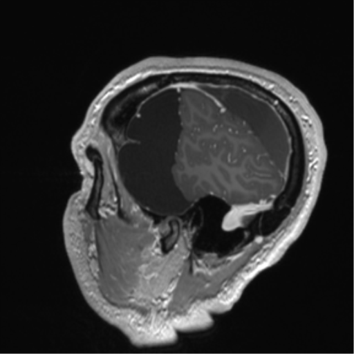 Arachnoid cyst with subdural hematoma (Radiopaedia 85892-101743 Sagittal T1 C+ 19).png