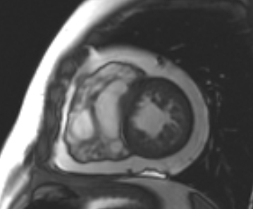 File:Arrhythmogenic right ventricular cardiomyopathy (Radiopaedia 69431-79307 Short axis cine 90).jpg