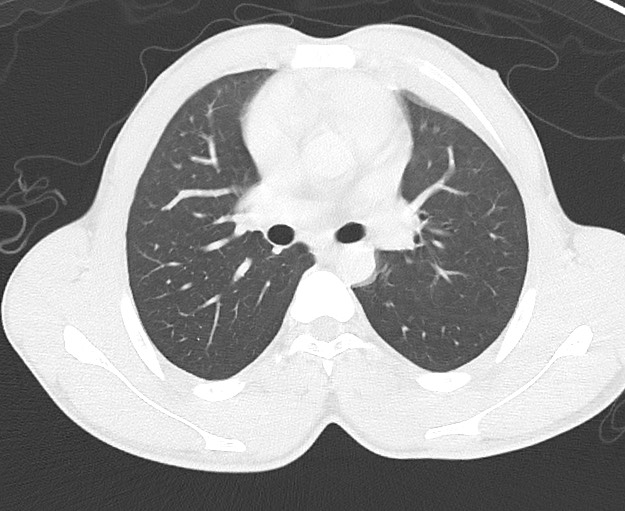 Arrow injury to the chest (Radiopaedia 75223-86321 Axial lung window 30).jpg