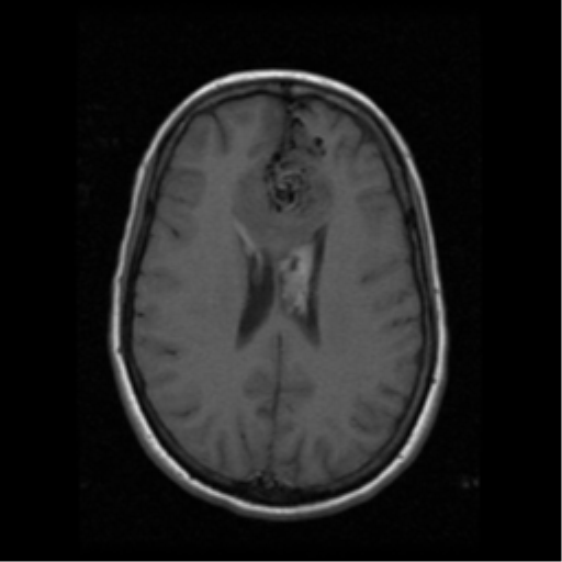 File:Arteriovenous malformation (cerebral) (Radiopaedia 40070-42580 Axial T1 14).png