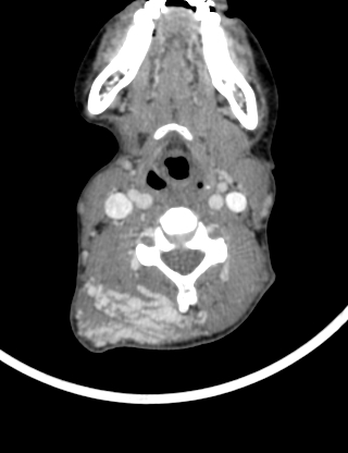 File:Arteriovenous malformation of the neck (Radiopaedia 53935-60062 B 24).jpg