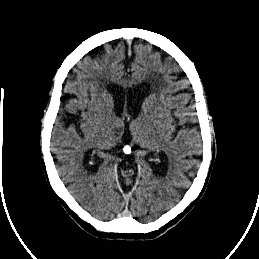 File:Artery of Percheron infarction (Radiopaedia 26307-26438 Axial non-contrast 18).jpg