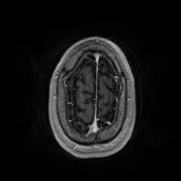 File:Artery of Percheron infarction (Radiopaedia 27975-28230 Axial T1 C+ fat sat 90).jpg