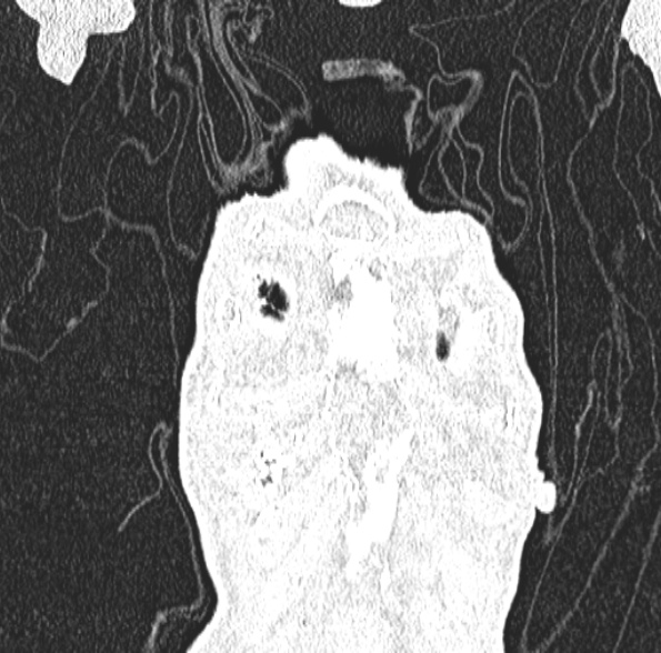 Aspergilloma- with Monod sign (Radiopaedia 44737-48532 Coronal lung window 123).jpg