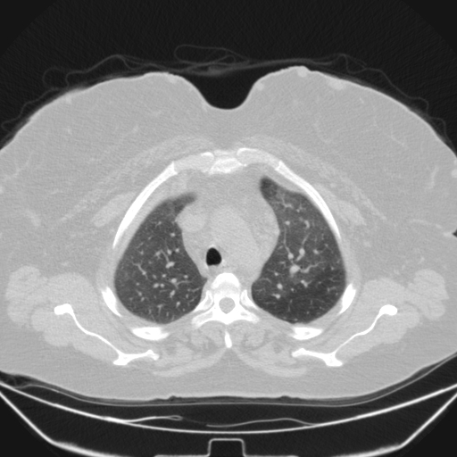 Aspergilloma (Radiopaedia 39611-41932 Axial lung window 27).jpg