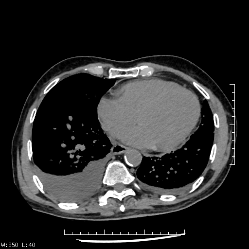 File:Aspergilloma (Radiopaedia 75184-86270 Axial liver window 29).jpg