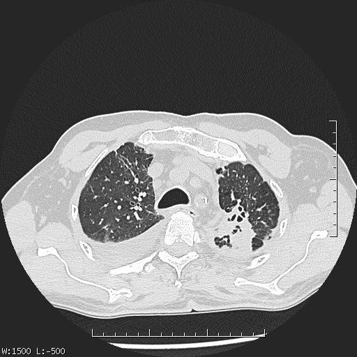 Aspergilloma (Radiopaedia 75184-86270 Axial lung window 12).jpg